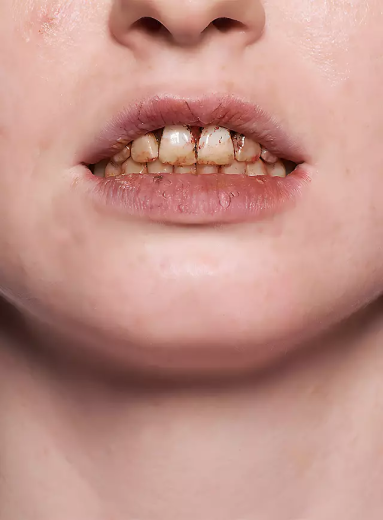 Zahnlack Nikotin| Pinselflasche [10ml]